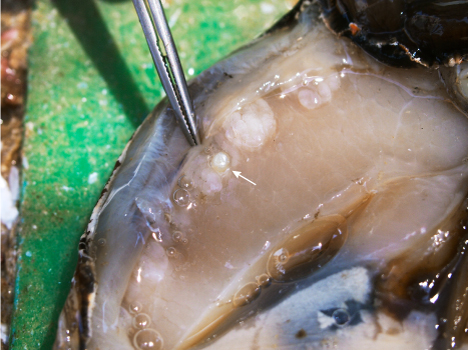 Seed pearl found embedded in the adductor muscle