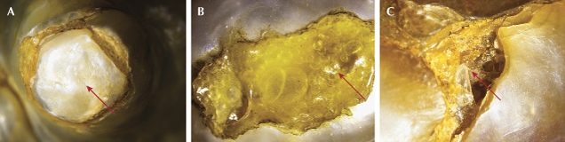Figure 2. A: Plugged area showing shell piece in the 34.30 ct pearl. B: Trapped gas bubbles in adhesive in the 75.86 ct pearl. C: Adhesive-filled cracks and broken nacre in the 98.53 ct pearl. Photomicrographs by Nitin Wadgaonkar; fields of view 3.00 mm.