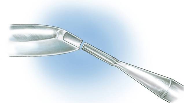 Use a cylinder burr to make a grooved prong pusher